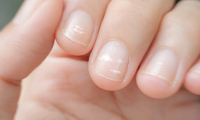 Почему на ногтях появляются белые пятна и как от них избавиться